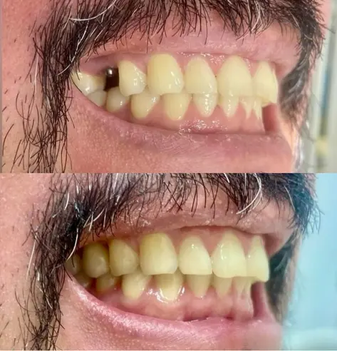 Antes e depois de implante — paciente da Brivva