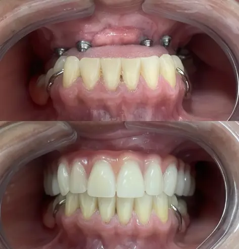 Antes e depois de implante — paciente da Brivva