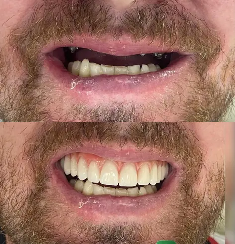 Antes e depois de implante — paciente da Brivva